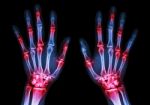 Film X-ray Both Human's Hands And Arthritis At Multiple Joint (gout,rheumatoid) Stock Photo