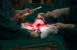 Cesarean Section Stock Photo