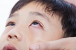 Closeup Pinkeye (conjunctivitis) Infection Stock Photo