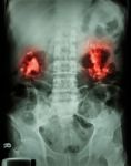 Bilateral Renal Calculi(staghorn) Stock Photo