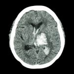 Ct Brain : Show Left Thalamic Hemorrhage (hemorrhagic Stroke) Stock Photo