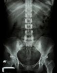 X-ray Lumbo-sacral Spine And Pelvis Of Asian Adult People Stock Photo