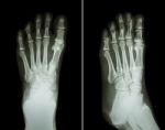 Film X-ray Both Foot ( 2 Position : Front View And Side View ) Stock Photo