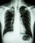 Pulmonary Tuberculosis Stock Photo