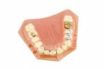 Dental Model (with Different Treatments) Stock Photo