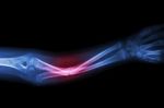 X-ray Fracture Ulnar Bone (forearm Bone) Stock Photo