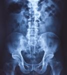 X-ray Pelvis And Spinal Column Stock Photo