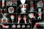 X-ray Multiple Part Of Child 's Body & Multiple Disease ( Stroke , Brain Tumor , Rheumatoid Arthritis , Sinusitis , Gouty Arthritis , Etc)( Skull Chest Lung Heart Spine Arm Hand Pelvis Leg Knee Foot ) Stock Photo