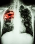 Mycobacterium Tuberculosis Infection (pulmonary Tuberculosis) Stock Photo