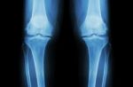 Osteoarthritis Knee ( Oa Knee ). Film X-ray Both Knee ( Front View ) Show Narrow Joint Space ( Joint Cartilage Loss ) , Osteophyte , Subchondral Sclerosis Stock Photo