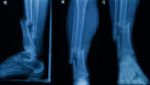 Collection Of Human X-rays  Showing Fracture Of Right Leg ( Fracture Both Bones ) Stock Photo