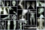 Collection X-ray Multiple Part Of Human & Orthopedic Surgery & Multiple Disease (osteoarthritis Knee,spondylosis,stroke,fracture Bone,pulmonary Tuberculosis, Etc) Stock Photo