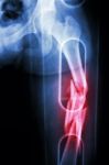 Film X-ray Show Comminute Fracture Shaft Of Femur (thigh Bone). It Was Spliced Stock Photo