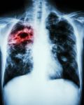 Mycobacterium Tuberculosis Infection (pulmonary Tuberculosis) Stock Photo