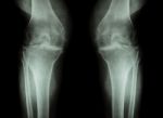 Osteoarthritis Knee ( Oa Knee ) ( Film X-ray Both Knee With Arthritis Of Knee Joint : Narrow Knee Joint Space ) ( Medical And Science Background ) Stock Photo