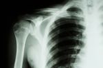 Fracture Middle Right Clavicle Stock Photo