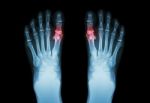 Gout , Rheumatoid Arthritis ( Film X-ray Both Foot And Arthritis At First Metatarsophalangeal Joint ) ( Medicine And Science Background ) Stock Photo