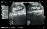 Ultrasonography Of Kidney : Show Left Kidney Stone ( 2 Image For Compare ) Stock Photo