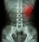 Kidney Stone ( Renal Stone , Renal Calculi ) ( Film X-ray Kub ( Kidney - Ureter - Bladder ) Show Left Renal Stone ) Stock Photo