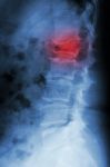 Film X-ray Lumbar Spine Lateral : Show Burst Fracture At Lumbar Stock Photo