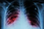 Pulmonary Tuberculosis ( Tb )  :  Chest X-ray Show Alveolar Infiltration At Both Lung Due To Mycobacterium Tuberculosis Infection Stock Photo