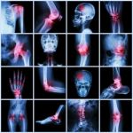 Collection Human Joint And Arthritis And Stroke Stock Photo