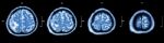 Brain Tumor  ( Film Ct-scan Of Brain : Show Part Of Brain With Tumor ) Stock Photo