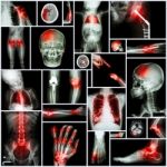 Collection Of X-ray Multiple Part Of Human,orthopedic Operation And Multiple Disease (shoulder Dislocation,stroke,fracture,gout,rheumatoid Arthritis,bronchiectasis,osteoarthritis Knee, Etc ) Stock Photo