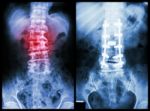 "spondylosis" (left Image) , Patient Was Operated And Internal Fixed. (right Image) Stock Photo