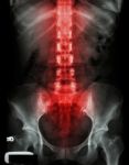 X-ray Lumbo-sacral Spine And Pelvis And Inflammation At Spine Stock Photo