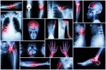 Collection X-ray Multiple Disease (stroke ,fracture ,osteoarthritis ,pneumonia ,tuberculosis ,spondylosis ,spondylolisthesis ,gout ,rheumatoid Arthritis ,brain Tumor ,orthopedic Operation ,etc) Stock Photo