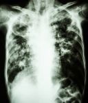 Mycobacterium Tuberculosis Infection (pulmonary Tuberculosis) Stock Photo