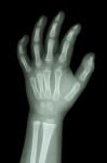 X-ray Infant's Hand Stock Photo