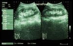 Ultrasonography Of Kidney : Show Left Kidney Stone ( 2 Image For Compare ) Stock Photo