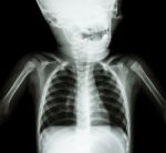 X-ray Skull And Chest Of Child Stock Photo