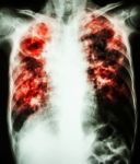 Mycobacterium Tuberculosis Infection (pulmonary Tuberculosis) Stock Photo