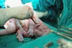 New Born Infant In The Operation Room Stock Photo