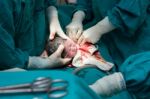 Cesarean Section Stock Photo