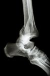 Fracture Tibia & Fibula (leg's Bone) And Ankle Dislocation Stock Photo