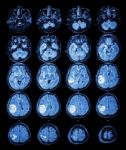 Mri Brain : Brain Tumor At Right Parietal Lobe Stock Photo