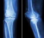 Osteoarthritis Knee .  Film X-ray Knee ( Anterior - Posterior And Lateral View )  Show Narrow Joint Space , Osteophyte ( Spur ) , Subcondral Sclerosis Due To Degenerative Change Stock Photo