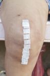 Knee Replacement Incision Stock Photo