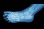 Film X-ray Of Child 's Foot ( Side View ) ( Lateral ) Stock Photo