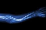 Fracture Ulnar Bone (forearm Bone) Stock Photo