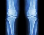 Osteoarthritis Both Knee .  Film X-ray Ap ( Anterior - Posterior ) Of Knee Show Narrow Joint Space , Osteophyte ( Spur ) , Subcondral Sclerosis Stock Photo