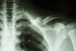 Fracture Left Clavicle Stock Photo