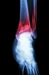 Film X-ray Ankle Show Fracture Distal Tibia And Fibula (leg's Bone) Stock Photo