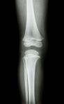 Film X-ray Knee Ap(antero-posterior) Of Child Stock Photo