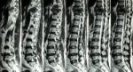 Mri Of Lumbar & Thoracic Spine : Show Fracture Of Thoracic Spine And Compress Spinal Cord ( Myelopathy ) Stock Photo