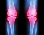 Osteoarthritis Both Knee .  Film X-ray Ap ( Anterior - Posterior ) Of Knee Show Narrow Joint Space , Osteophyte ( Spur ) , Subcondral Sclerosis Stock Photo